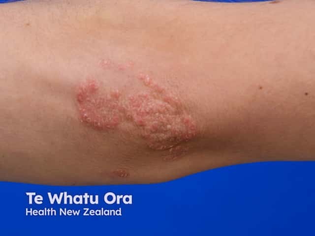 Plaque psoriasis on the elbow - the linear area at the proximal pole of the lesion represents koebnerisation after a scratch