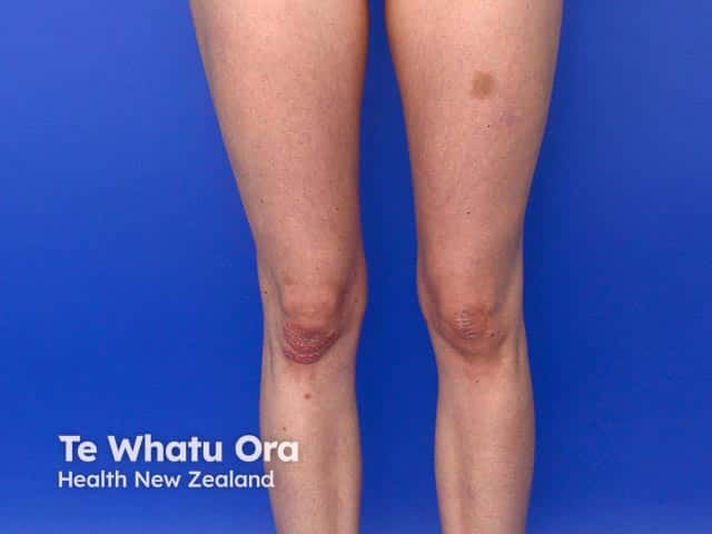Typical psoriasis on the right knee - it is unusual in that psoriasis is usually symmetrical