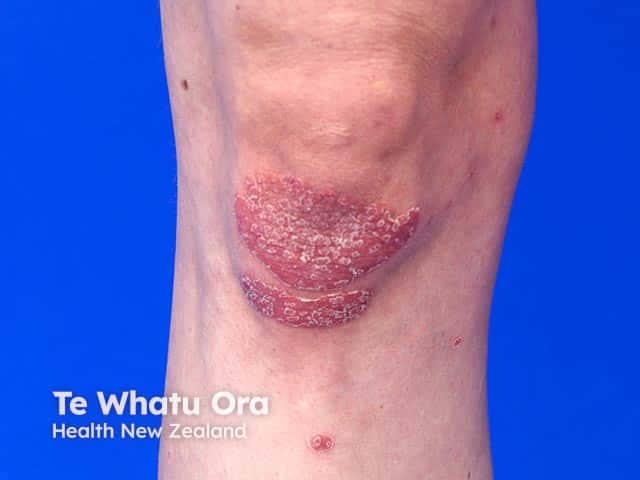 SIlvery scaled well-demarcated plaques of psoriasis on the knee