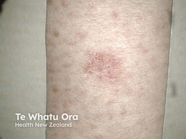 Mild psoriasis on the forearm - the silvery scale can be accentuated by gentle scratching