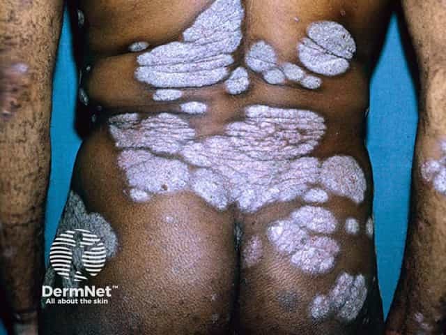 Extensive well-circumscribed plaques of psoriasis in skin of colour