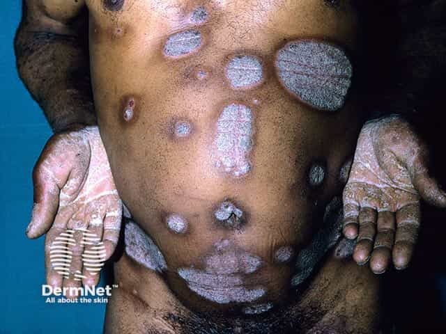 Extensive well-circumscribed plaques of psoriasis in skin of colour