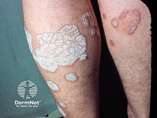 Thick scale overlying plaques of psoriasis on the leg