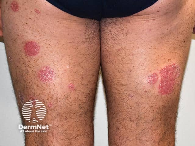 Well-circumscribed plaques of psoriasis on the legs