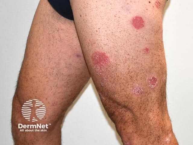 Well-circumscribed plaques of psoriasis on the legs