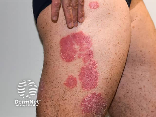 Well-circumscribed red patches of psoriasis - mild scratching will accentuate the scale