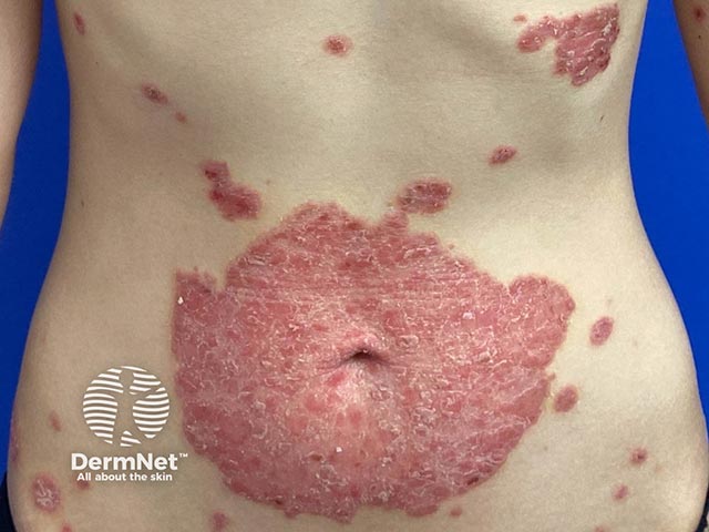 Chronic plaque psoriasis on the abdomen