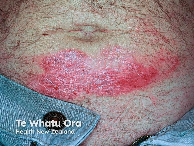 Psoriasis koebnerising into an area of nickel contact allergy from a jean stud