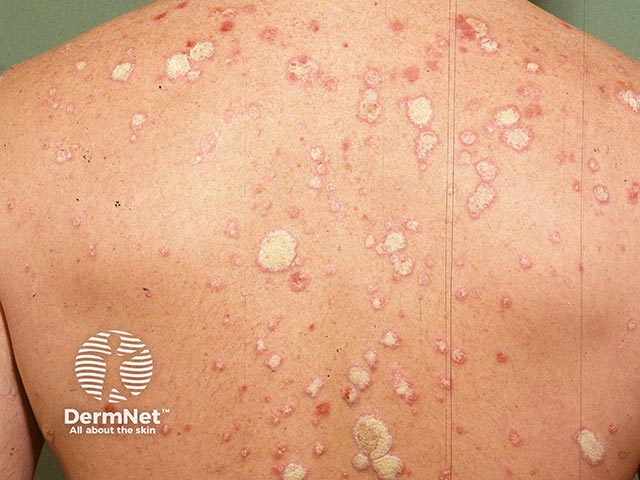 Chronic plaque psoriasis on the back
