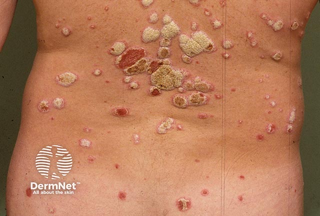 Thick scaly plaques of psoriasis on the trunk