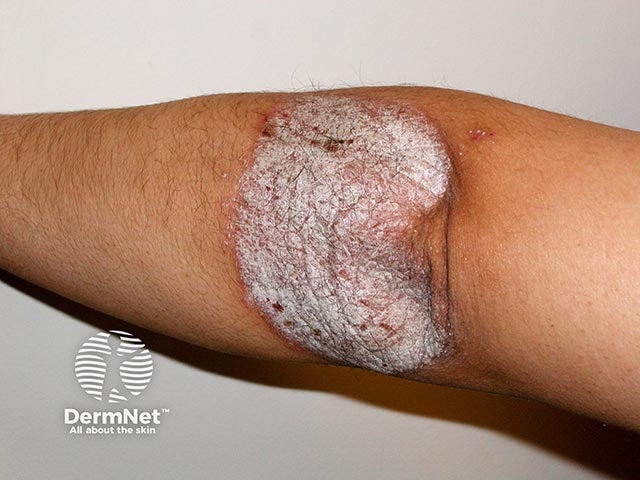 Thick well-demarcated silvery scale of psoriasis on the elbow
