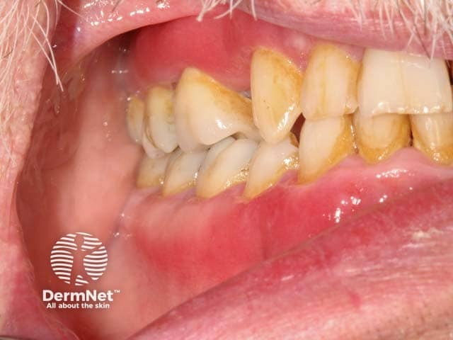 Red, glazed and oedematous changes on the gingivae in plasma cell mucositis