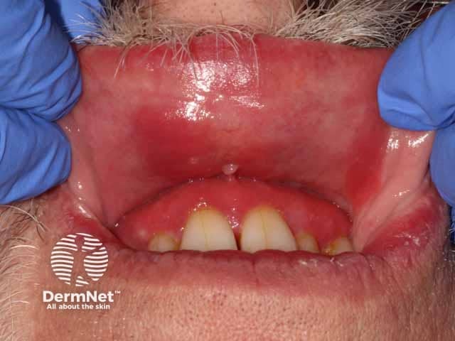 Red, glazed and oedematous changes on the gingiva and buccal mucosa in plasma cell mucositis