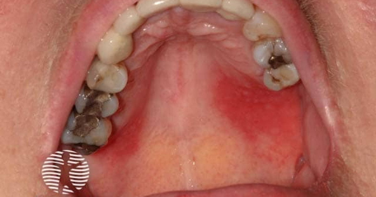 Plasma cell mucositis image