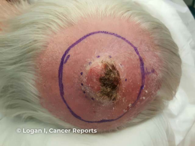 A pleomorphic dermal sarcoma on the scalp prior to wide local excision 