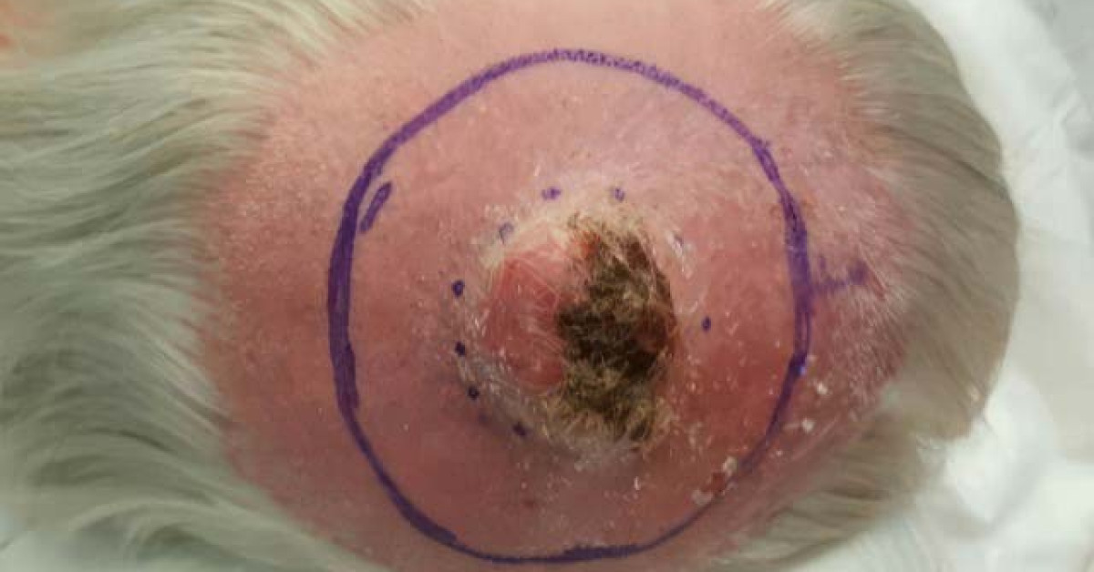 Pleomorphic dermal sarcoma image