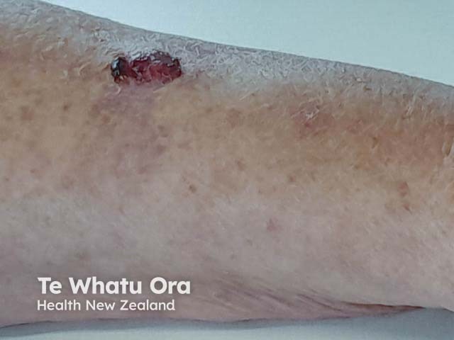 An ulcerated bleeding, crusted nodule on the arm which on histology was a pleomorphic dermal sarcoma