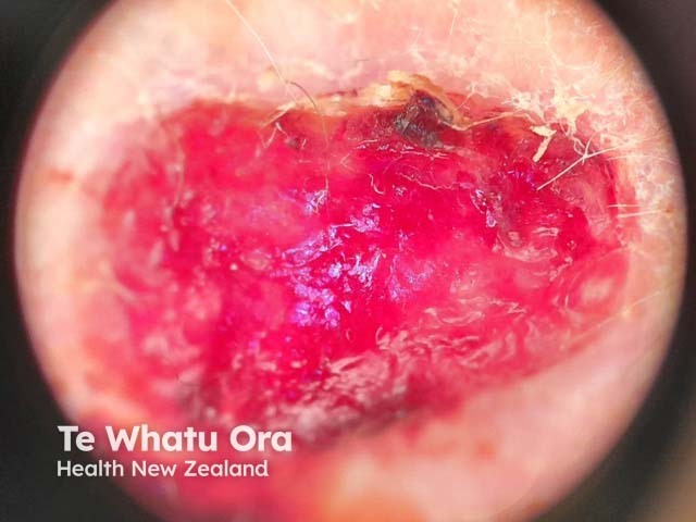 Dermoscopy of a pleomorphic dermal sarcoma