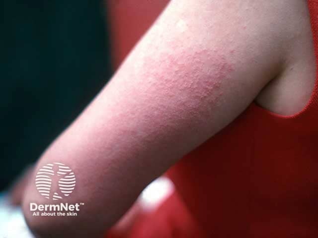 Papulovesicular polymorphic light eruption on the arm