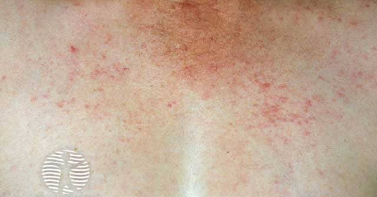 Polymorphic light eruption image