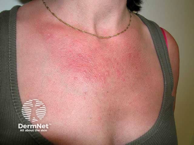 Coalescing papular polymorphic light eruption on the chest