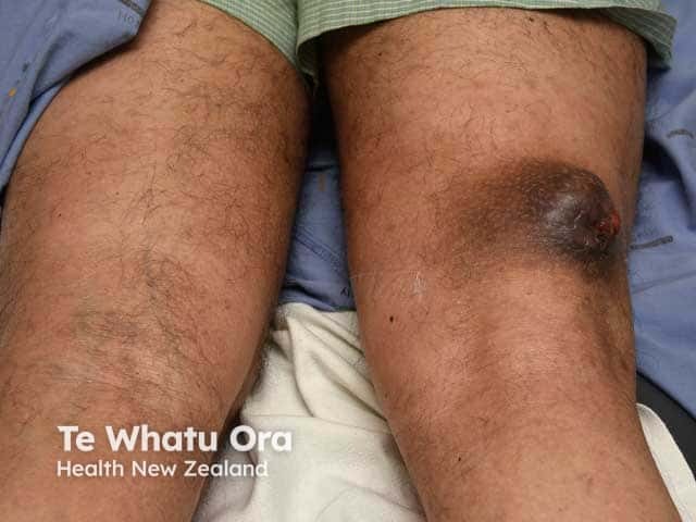 Porocarcinoma: thigh