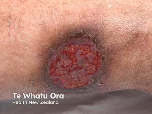 Porocarcinoma: surgical wound on thigh