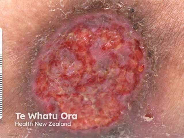 Porocarcinoma: surgical wound