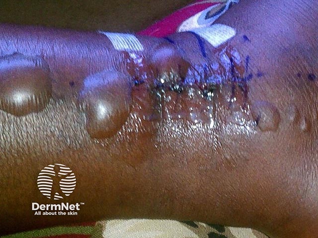 Fracture blisters due to acute oedema after an ankle fracture