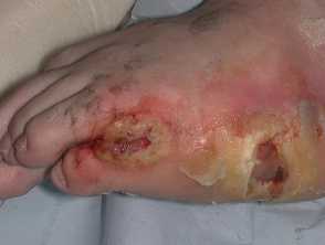 Bedsores (pressure ulcers): Treatments, stages, causes, and pictures