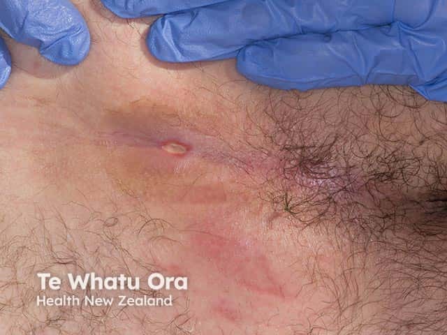 A pressure ulcer on the sacrum - spinal injury has resulted in immobility and anaesthesia of the affected area