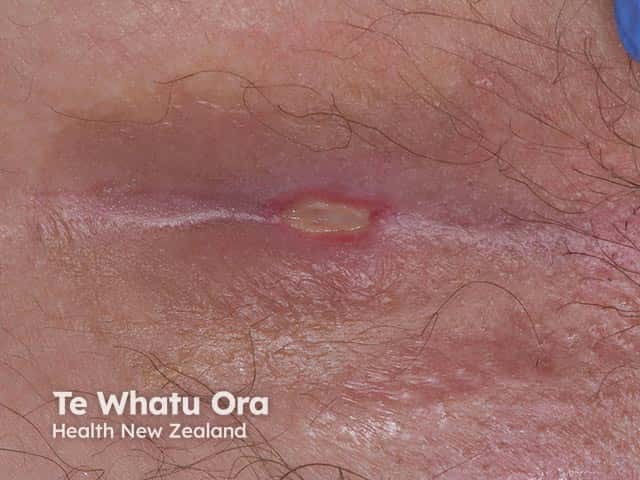 A pressure ulcer on the sacrum
