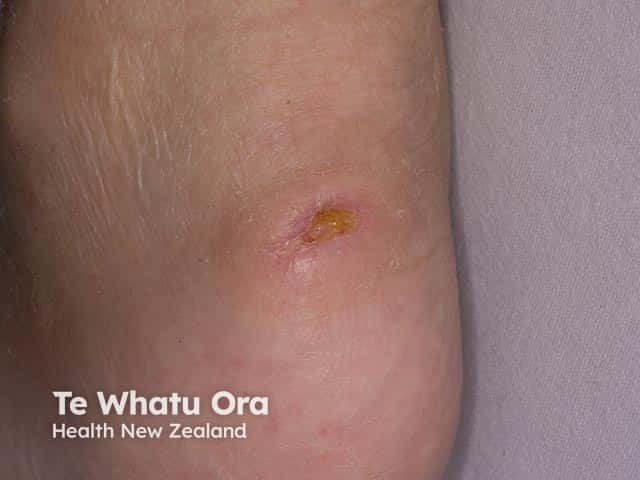 Pressure ulcer on the heel of a 61 year old male following a spinal injury