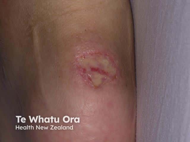 Pressure ulceration on the elbow in a quadraplegic man after a spinal injury