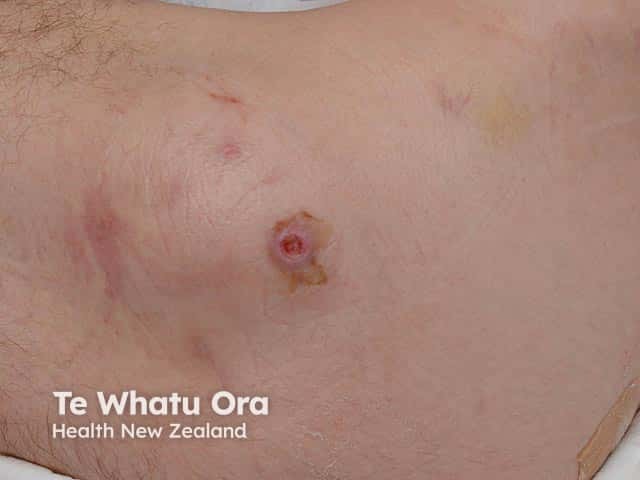 A pressure ulcer on the hip of a 39 year old male with cerebral aneurysm-induced quadriplegia