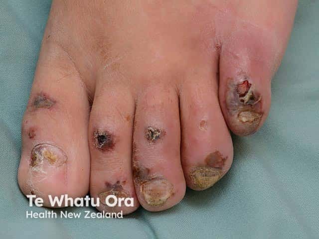Ulcers on the pressure points of the digits - the patient had neuropathic feet due to a cerebral haemorrhage