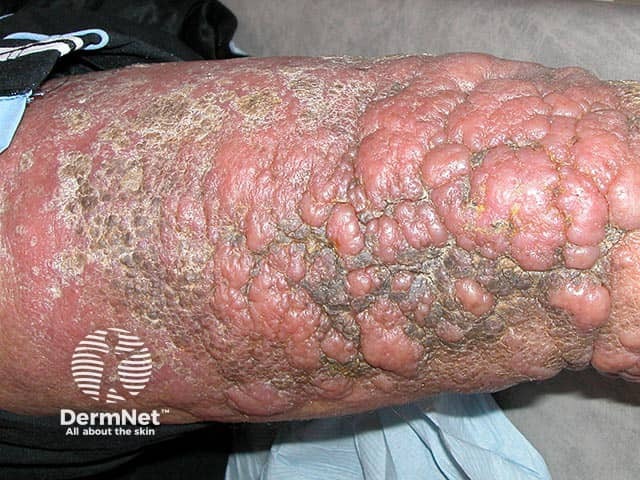 Gross elephantiasic plaques of myxoedema on the leg