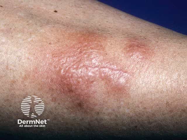 Graves Dermopathy Mild Graves Disease Causes Symptoms And Treatment