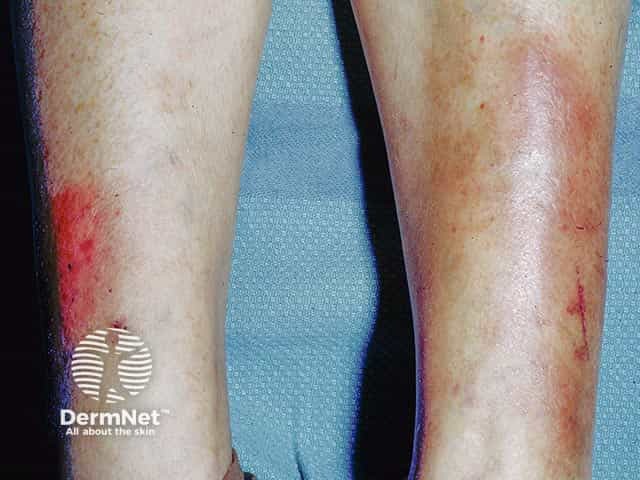 Pretibial myxoedema showing yellow-brown patches on the shin