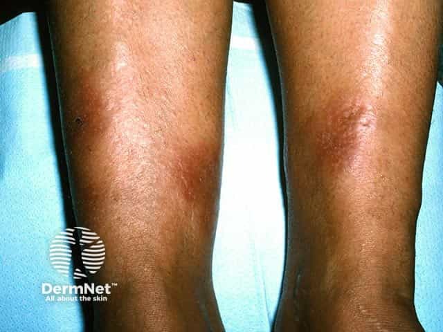 Bilateral orange-red swellings on the lower leg in pretibial myxoedema