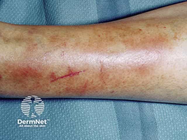 Red-brown patches on the shin - biopsy showed mucin accumulation confirming pretibial myxoedema