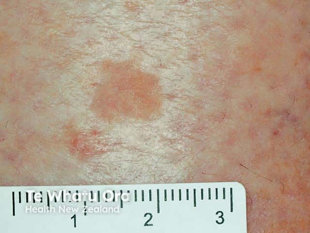 Close-up of a patch of early pretibial myxoedema