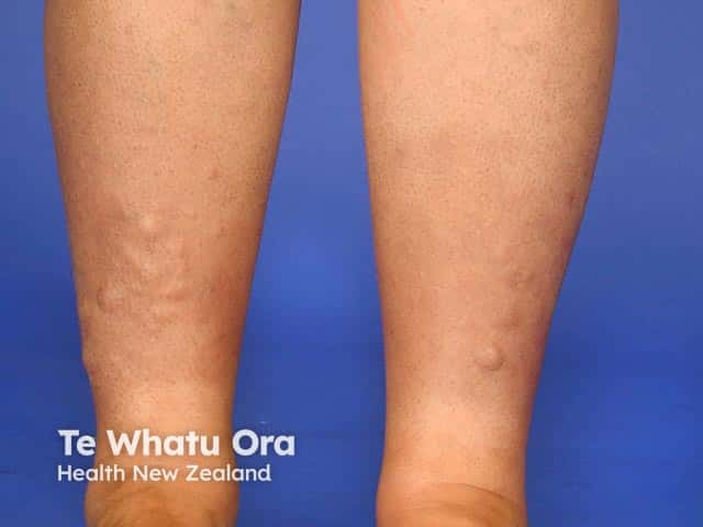 Pale nodules of pretibial myxoedema in skin of colour on the lower leg