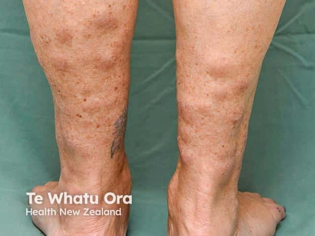 Mucin accumulation around the ankles causing nodules and plaques due to pretibial myxoedema