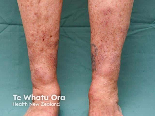 Mucin accumulation around the ankles causing nodules and plaques due to pretibial myxoedema