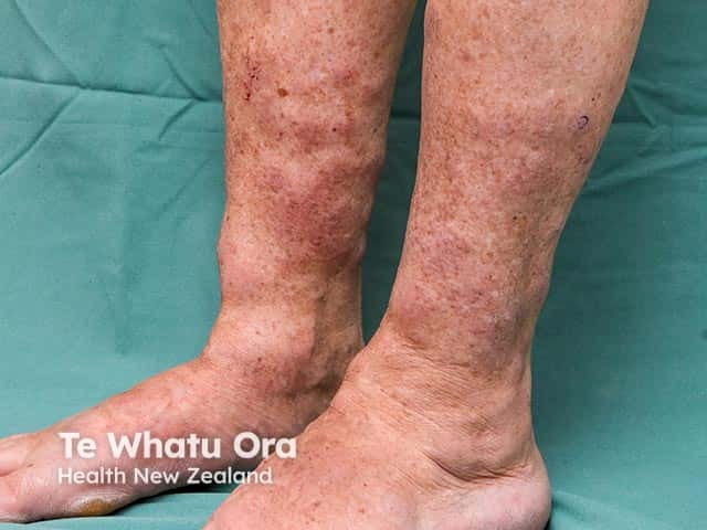 Bilateral infiltrative plaques on the lower shins and ankle due to mucin accumulation in pretibial myxoedema