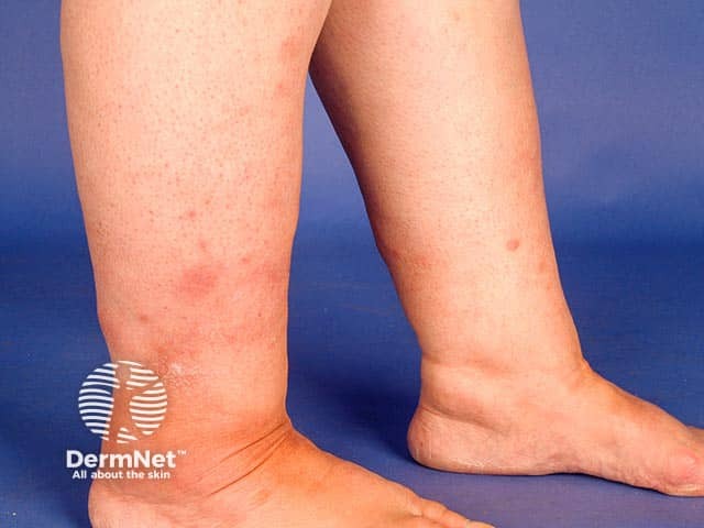 Orange-red plaques around the ankles in pretibial myxoedema
