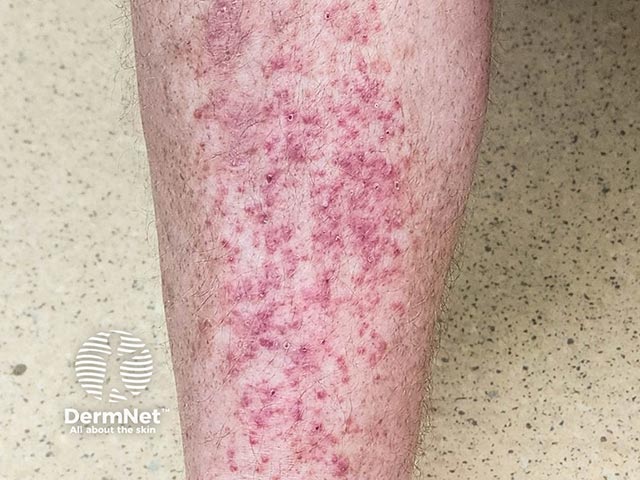 Itchy erythematous and purpuric hyperkeratotic papules on the shin in PPPD