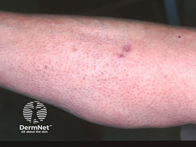 The purple nodules showed plasmacytosis - there is a surrounding follicular eruption