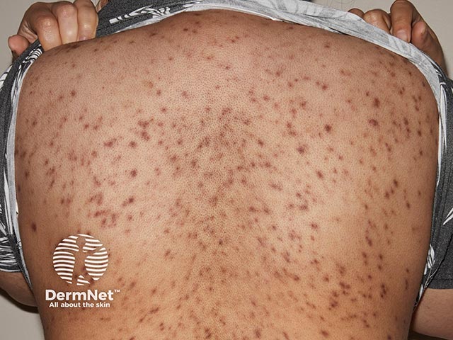 Multiple pigmented papules over the trunk - biopsy showed primary cutaneous plasmacytosis